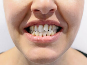 alinhadores invisíveis